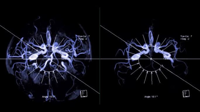 大脑中的血管MRA或磁共振血管造影 (MRA) 在屏幕上转动。MRA脑MIP视图用于评估脑动脉。