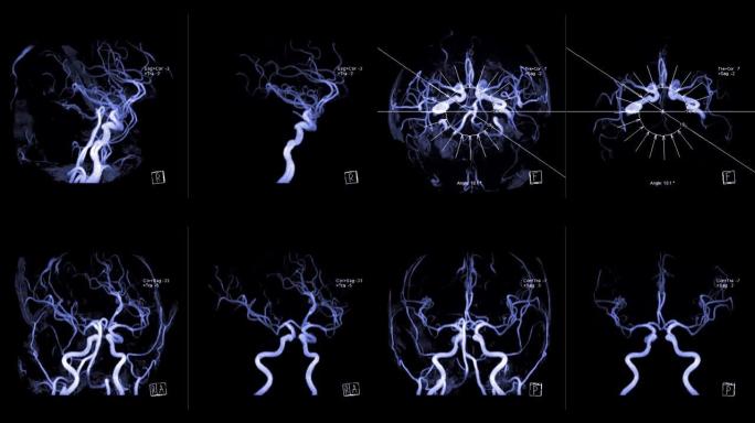 大脑中的血管MRA或磁共振血管造影 (MRA) 在屏幕上转动。MRA脑MIP视图用于评估脑动脉。