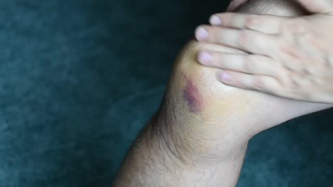 男子涂抹奶油和按摩受伤的膝盖。自己治疗扭伤和运动损伤。