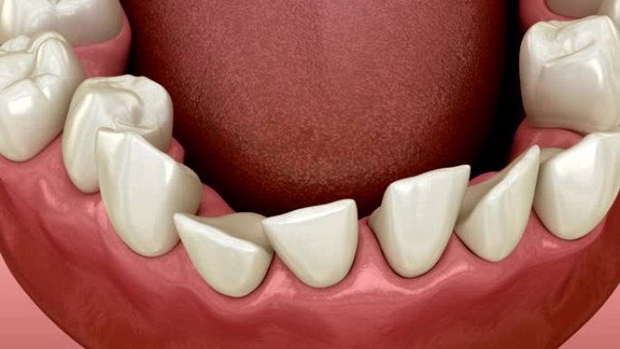 牙齿位置异常，正畸概念。医学上精确的牙齿3D动画