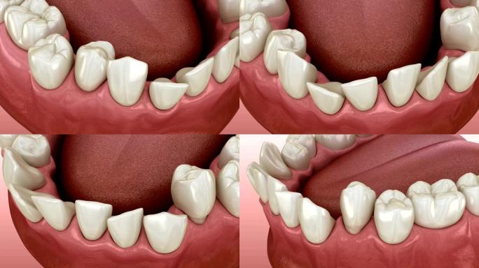 牙齿位置异常，正畸概念。医学上精确的牙齿3D动画