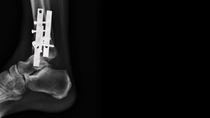 X光片胫骨骨折
