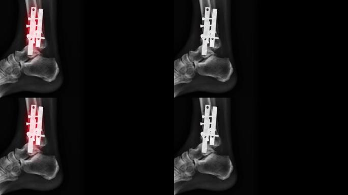 X光片胫骨骨折