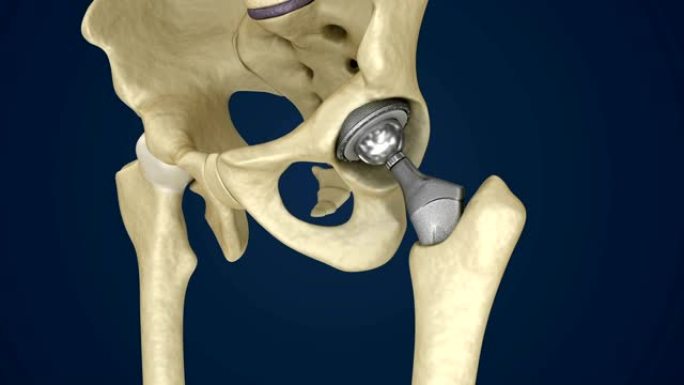 髋关节置换植入物安装在骨盆骨。医学上精确的3D动画