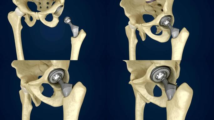 髋关节置换植入物安装在骨盆骨。医学上精确的3D动画