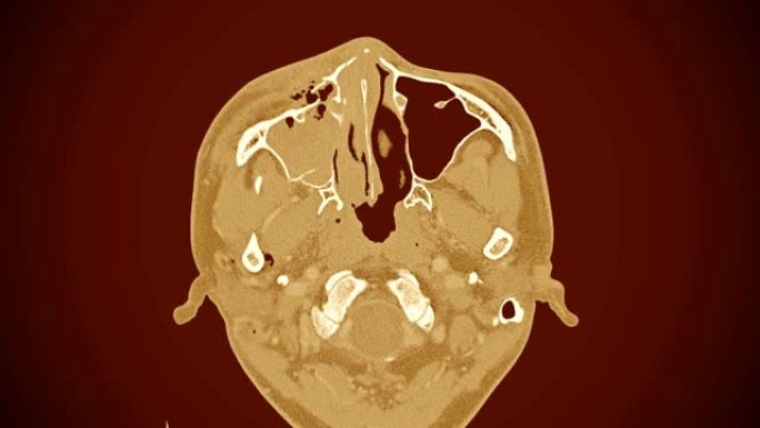 右眼眶外侧壁和内侧壁移位骨折的计算机断层扫描 (ct扫描)。