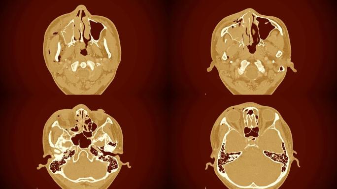 右眼眶外侧壁和内侧壁移位骨折的计算机断层扫描 (ct扫描)。