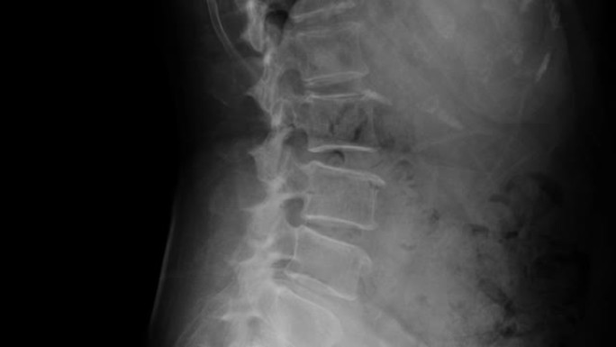 l型脊柱退行性改变的侧视图