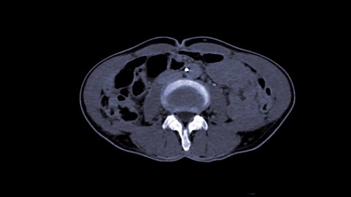 CT上腹部加造影剂后或化疗栓塞。