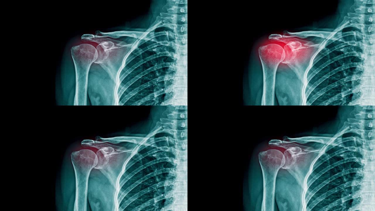 肩关节上带有红色高光的肩部疼痛x射线镜头