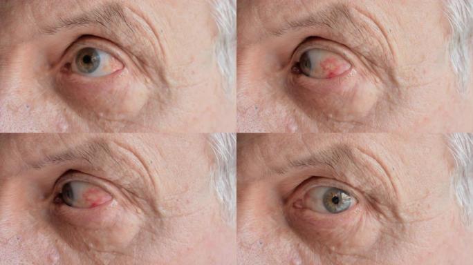 感染或高血压引起的红眼炎老人特写