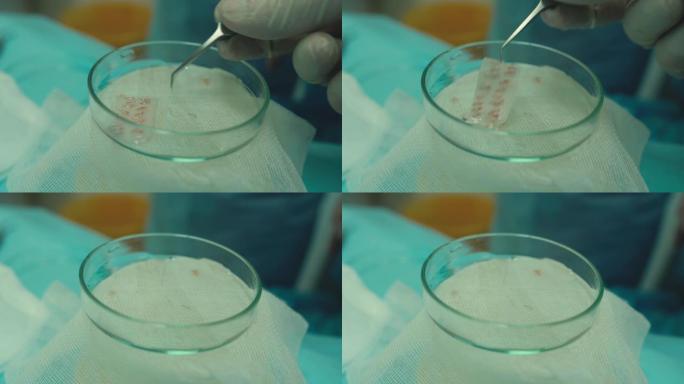 罩杯中的毛囊特写。秃发治疗。植发。手术室的外科医生进行植发手术。从毛囊的一部分移动毛囊的外科技术