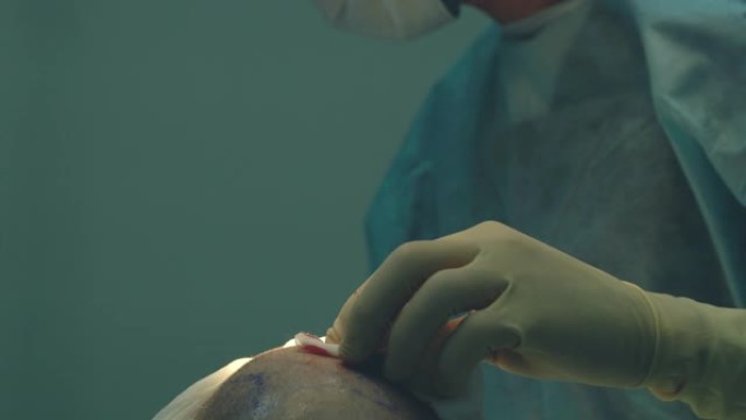 秃发治疗。植发。手术室的外科医生进行植发手术。从头部的一部分移动毛囊的外科技术