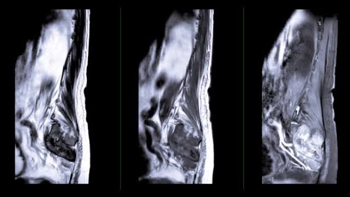 MRI在矢状面上的l-s脊柱或腰椎