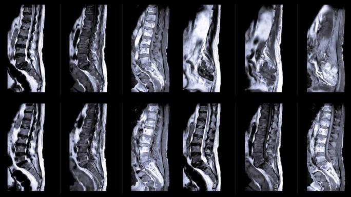 MRI在矢状面上的l-s脊柱或腰椎