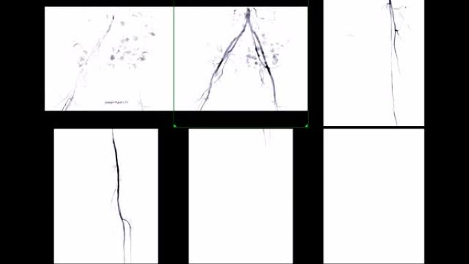 左股动脉血管造影的多视图显示白色背景上孤立的血管，用于诊断动脉粥样硬化。