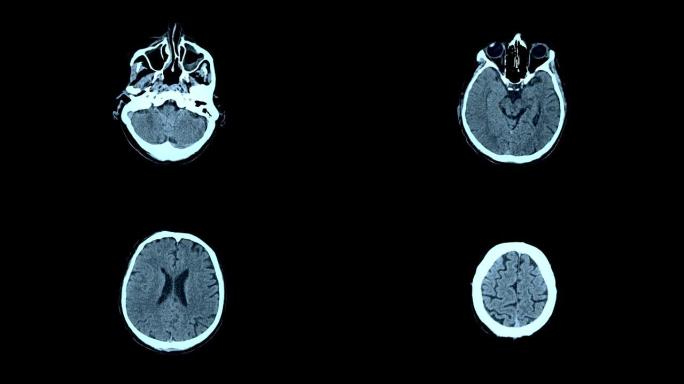磁共振成像脑MRI扫描