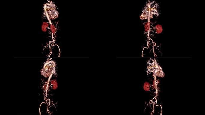 CTA整个主动脉3D渲染图像在屏幕上翻转以检测主动脉瘤。
