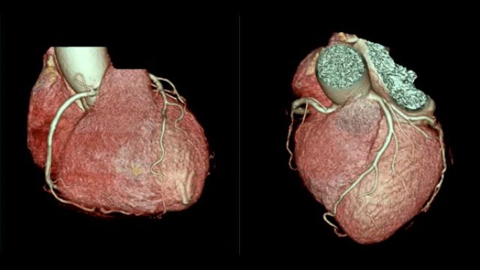 CTA冠状动脉3D渲染图像比较在屏幕上翻转以诊断血管冠状动脉狭窄。