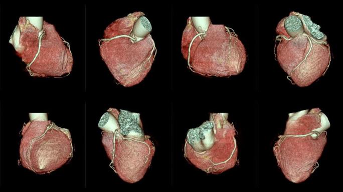 CTA冠状动脉3D渲染图像比较在屏幕上翻转以诊断血管冠状动脉狭窄。