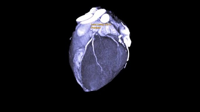 CTA冠状动脉3D渲染图像或冠状动脉树在屏幕上翻转以诊断血管冠状动脉狭窄。