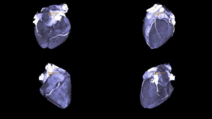 CTA冠状动脉3D渲染图像或冠状动脉树在屏幕上翻转以诊断血管冠状动脉狭窄。