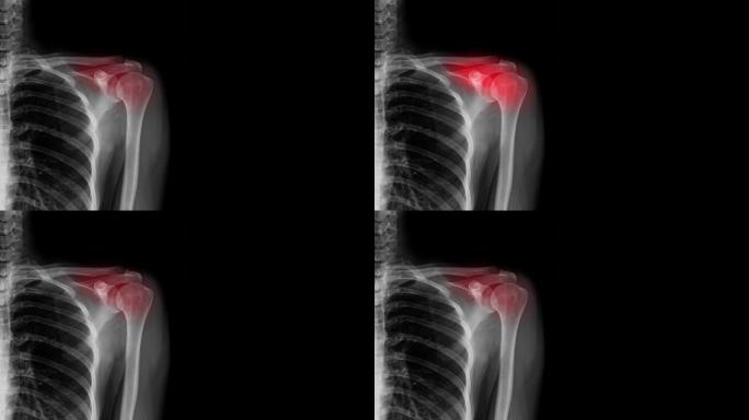 肩关节上带有红色高光的肩部疼痛x射线镜头