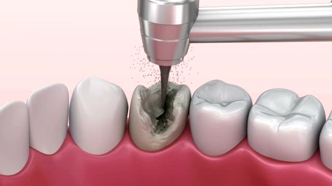 龋齿，治疗。医学上精确的牙齿3D动画。