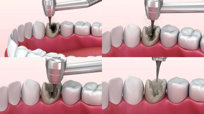 龋齿，治疗。医学上精确的牙齿3D动画。