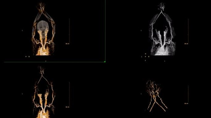 多视肱动脉CTA或上肢ct扫描三维渲染图像，用于诊断肱动脉狭窄。