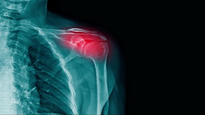 肩关节上带有红色高光的肩部疼痛x射线镜头