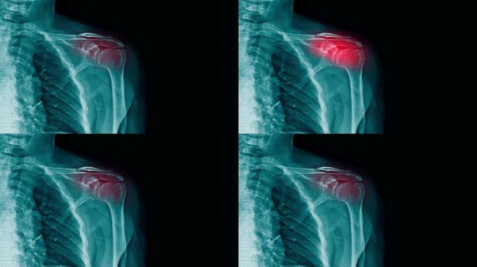 肩关节上带有红色高光的肩部疼痛x射线镜头