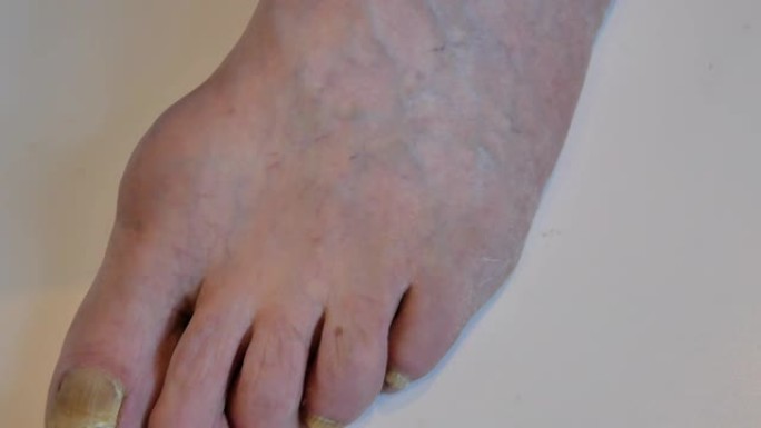 患有指甲真菌，静脉曲张，毛细血管网网格等疾病的老人的脚