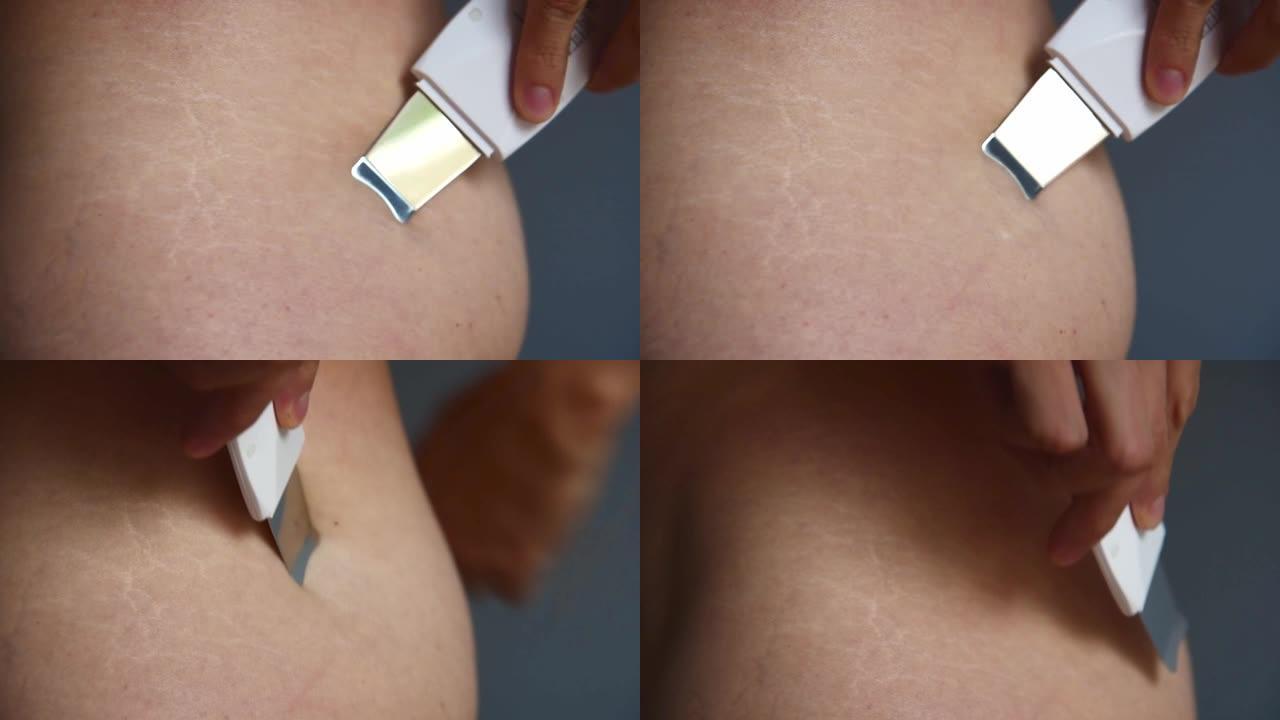 皮肤治疗电子设备治疗皮肤上的妊娠纹。