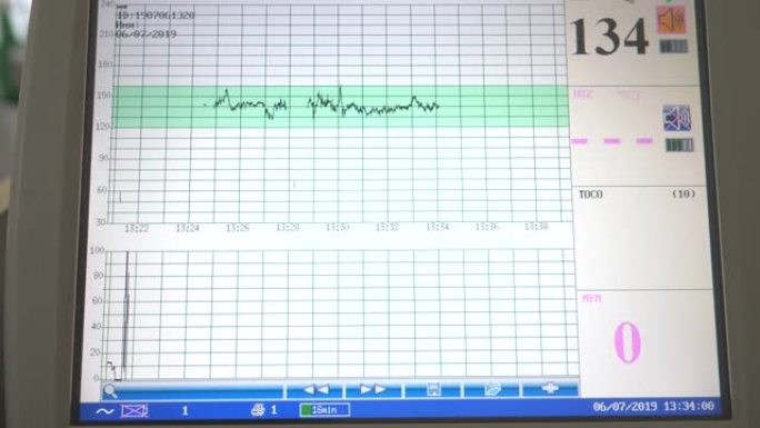 分娩时屏幕上的胎儿心率监测。