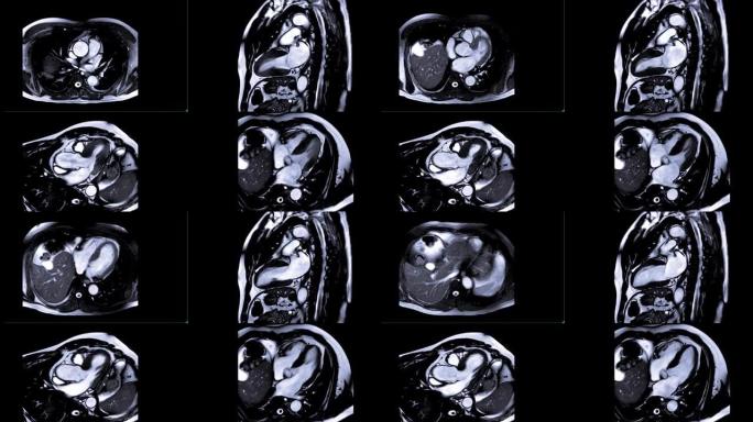心脏MRI或心脏磁共振成像比较轴位、2,3和4室心脏疾病的诊断。