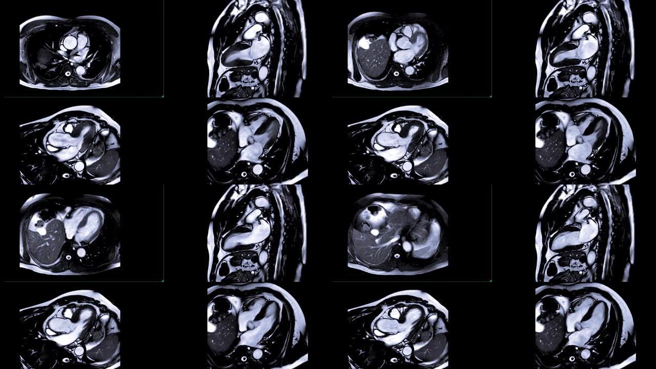心脏MRI或心脏磁共振成像比较轴位、2,3和4室心脏疾病的诊断。