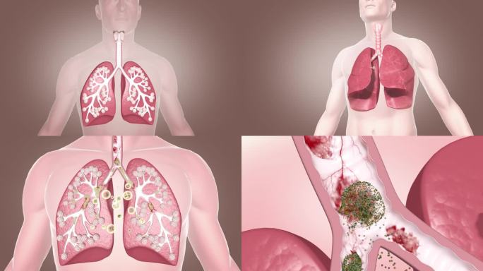 呼吸道感染 气管炎 祛痰 止咳