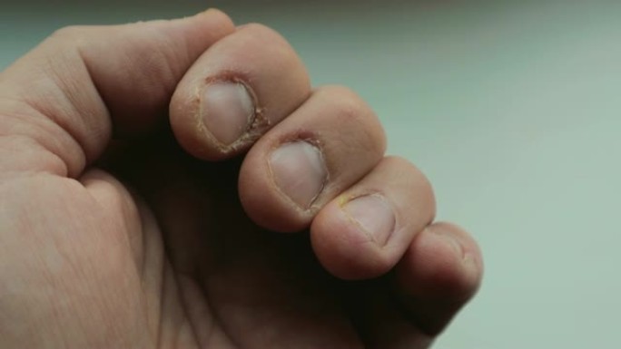 指甲受损，指甲和表皮干燥的人的手