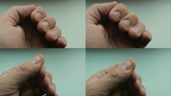 指甲受损，指甲和表皮干燥的人的手