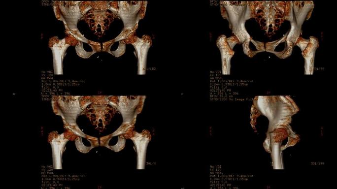 骨盆骨或双髋骨的ct扫描图像。
