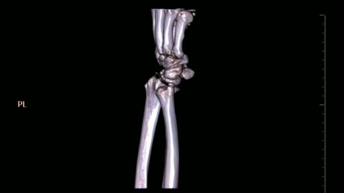 在黑色背景上旋转的左腕关节3D渲染图像的ct扫描。尺骨骨折。医疗技术概念。