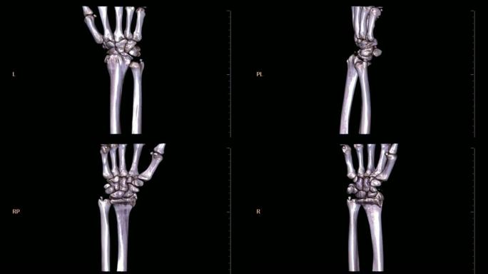 在黑色背景上旋转的左腕关节3D渲染图像的ct扫描。尺骨骨折。医疗技术概念。