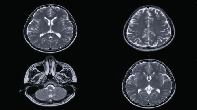 用造影剂在轴向平面上对大脑进行磁共振成像 (MRI)。中风概念。