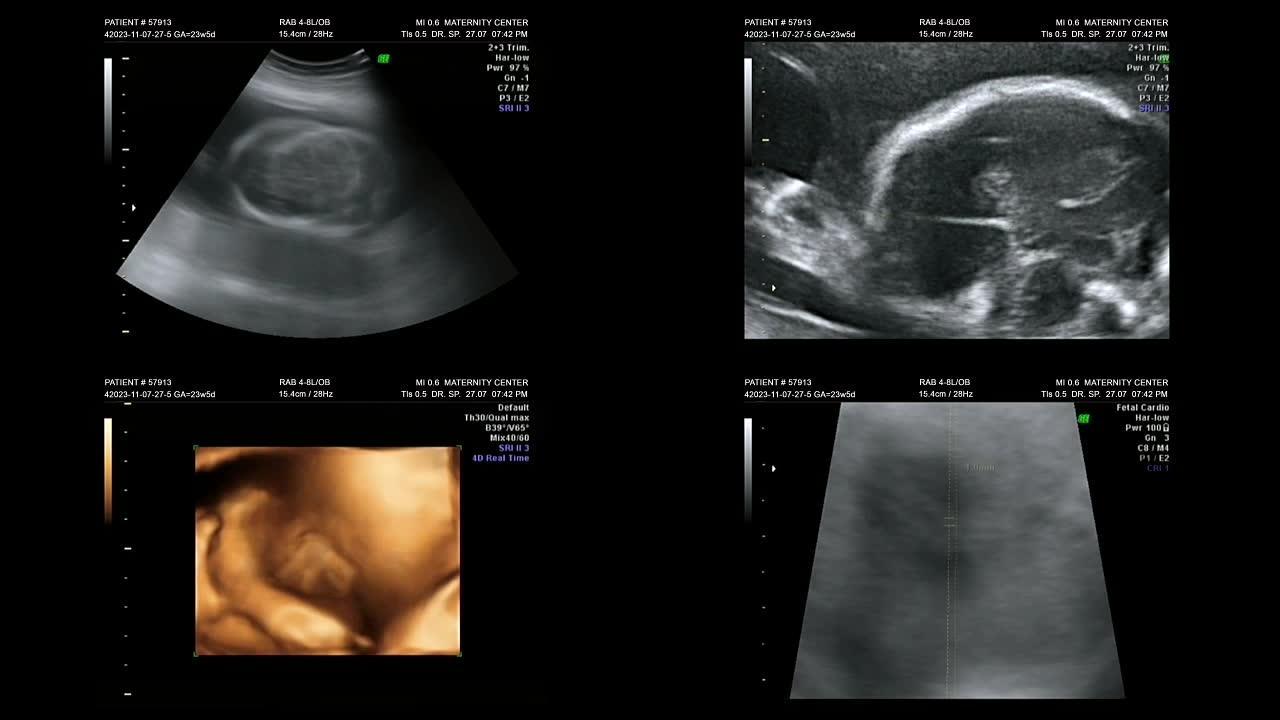 延时超声孕妇回声图显示