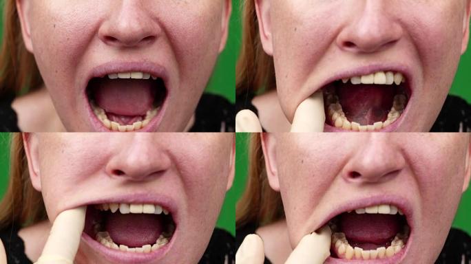 黄色牙齿的宏视频。牙齿被龋齿击中的特写镜头。口腔护理不良的概念。腐烂，难闻的气味，龋齿。嘴巴的特写
