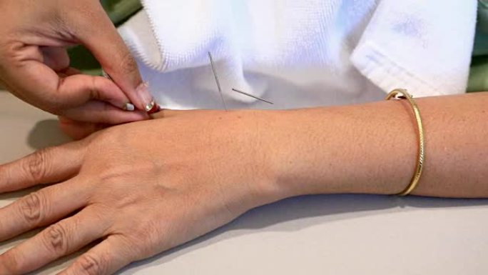 女性手接受针灸治疗