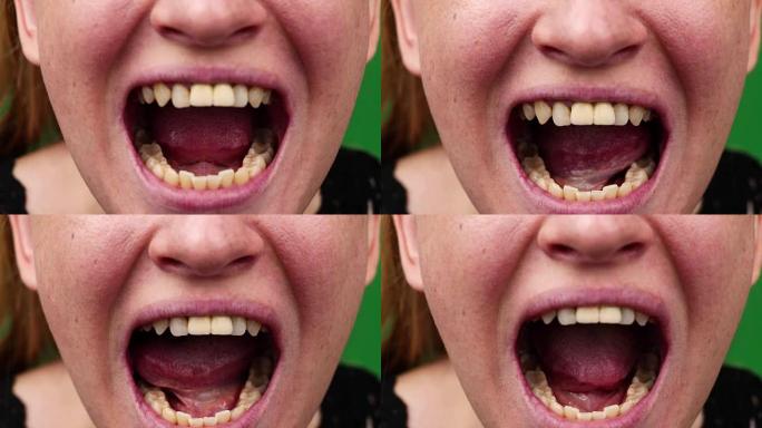 黄色牙齿的宏视频。牙齿被龋齿击中的特写镜头。口腔护理不良的概念。腐烂，难闻的气味，龋齿。嘴巴的特写