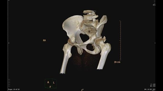 骨盆骨ct扫描。