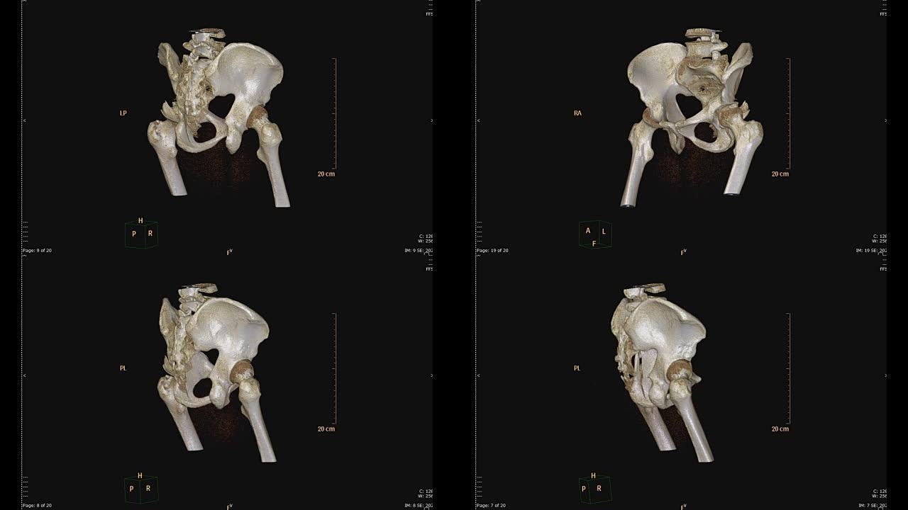 骨盆骨ct扫描。